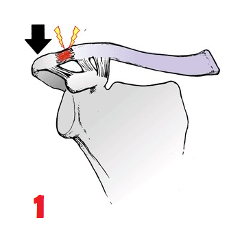 AC (Acromio-Clavicular) Joint Disruption | AC Joint Injury ...