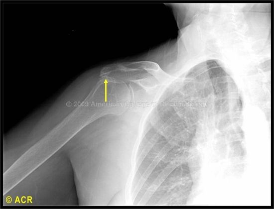 Subacromial Impingement Syndrome Shoulder Surgery