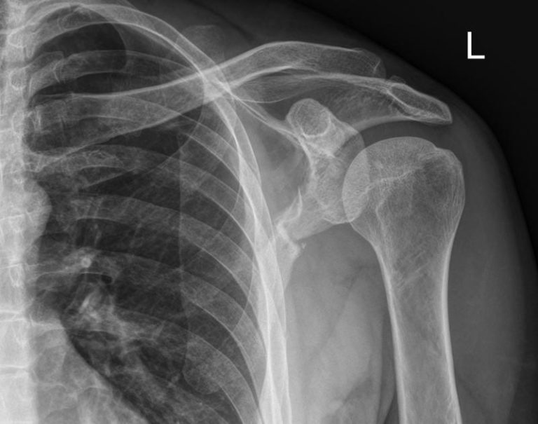 Shoulder Anatomy: Evaluation & Investigations | Shoulder Surgeon in ...