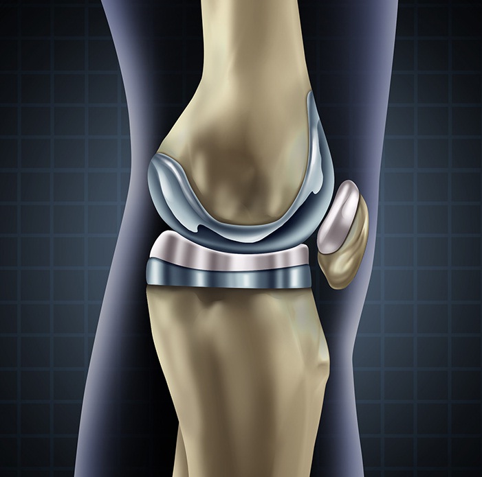 How Is Total Knee Replacement Surgery Performed Dr Amyn Rajani s Blog