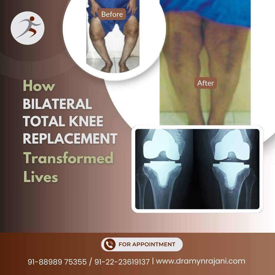 How Bilateral Total Knee Replacement Transformed Lives