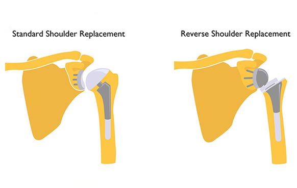 Reverse Shoulder Joint