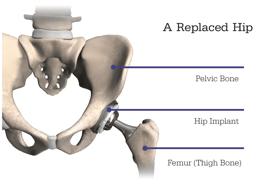 Robotic Total Hip Replacement