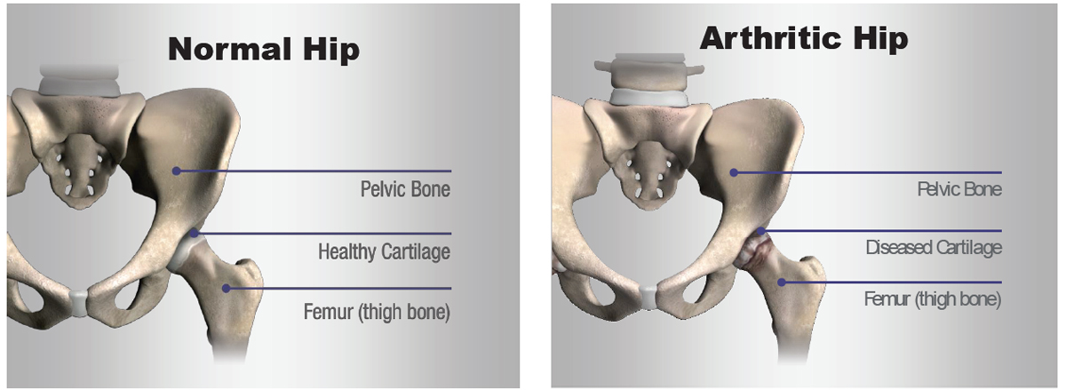 Robotic Total Hip Replacement