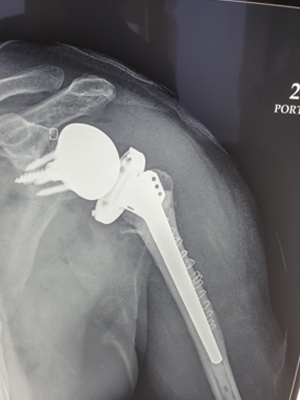 Post Reverse Shoulder Replacement Suregry X-ray for complex Fracture