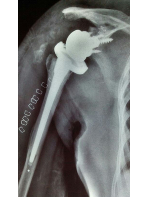 Post Surgery X-ray for Rotator Cuff Arthopathy