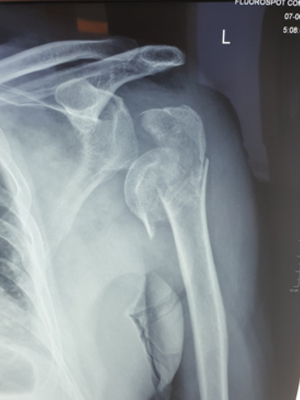 Pre Reverse Shoulder Replacement Suregry X-ray for complex Fracture