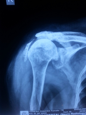 Pre Surgery X-ray for Rotator Cuff Arthopathy