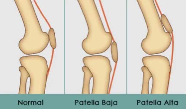 Patella Baja & Alta - Overview, Symptoms & Treatment 2 Patella Baja & Alta